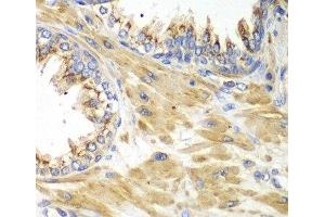 Immunohistochemistry of paraffin-embedded Human prostate using PICK1 Polyclonal Antibody at dilution of 1:100 (40x lens). (PICK1 antibody)