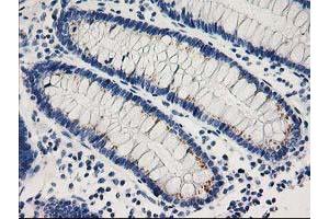 Immunohistochemical staining of paraffin-embedded Adenocarcinoma of Human breast tissue using anti-CDK2 mouse monoclonal antibody. (CDK2 antibody)