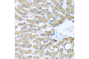 Immunohistochemistry of paraffin-embedded human liver injury using NDUFS3 antibody (ABIN5974479) at dilution of 1/100 (40x lens).