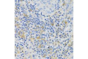 Immunohistochemistry of paraffin-embedded human lung cancer using PAK1 Antibody (ABIN5971674) at dilution of 1/100 (40x lens).