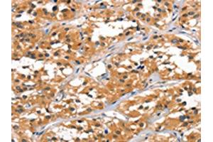 The image on the left is immunohistochemistry of paraffin-embedded Human thyroid cancer tissue using ABIN7189781(ALOX15 Antibody) at dilution 1/60, on the right is treated with synthetic peptide. (ALOX15 antibody)