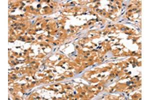 The image on the left is immunohistochemistry of paraffin-embedded Human thyroid cancer tissue using ABIN7189781(ALOX15 Antibody) at dilution 1/60, on the right is treated with synthetic peptide.