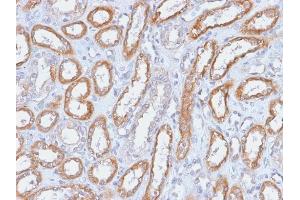 Formalin-fixed, paraffin-embedded human Renal Cell Carcinoma stained with CD61 Rabbit Recombinant Monoclonal Antibody (ITGB3/2166R). (Recombinant Integrin beta 3 antibody  (AA 385-490))