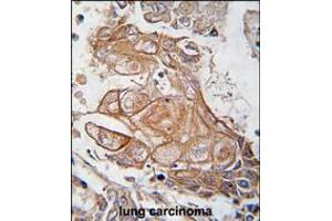 Formalin-fixed and paraffin-embedded human lung carcinoma tissue reacted with Phospho-RGS19-pS151. (RGS19 antibody  (AA 131-156))