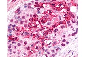 Anti-CXCR6 antibody IHC of human Breast, Carcinoma. (CXCR6 antibody  (Cytoplasmic Domain))