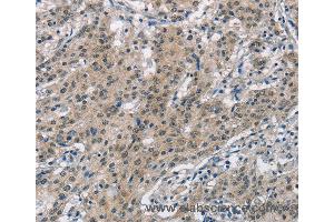 Immunohistochemistry of Human gastric cancer using SMAD9 Polyclonal Antibody at dilution of 1:30 (SMAD9 antibody)