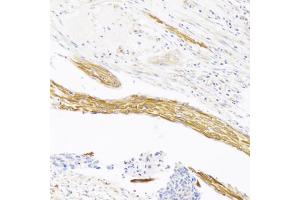 Immunohistochemistry of paraffin-embedded human esophageal cancer using VASH1 antibody (ABIN6290544) at dilution of 1:100 (20x lens). (VASH1 antibody)