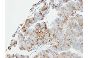 IHC-P Image Immunohistochemical analysis of paraffin-embedded GSTA2 xenograft, using GSTO1, antibody at 1:100 dilution. (GSTO1 antibody)