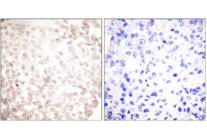 Immunohistochemistry analysis of paraffin-embedded human lung carcinoma tissue using XRCC1 antibody.