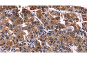 Immunohistochemistry of paraffin-embedded Human liver cancer tissue using NFATC3 Polyclonal Antibody at dilution 1:50 (NFATC3 antibody)