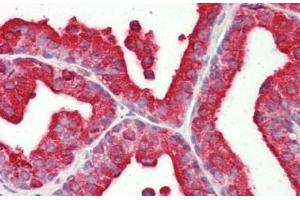 Formalin-Fixed, Paraffin-Embedded Human Prostate tissue stained with Acid Phosphatase Antibody at 1/200 after heat-induced antigen retrieval. (ACPP antibody)