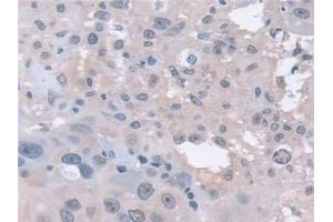 Detection of PSMa5 in Human Breast cancer Tissue using Polyclonal Antibody to Proteasome Subunit Alpha Type 5 (PSMa5)