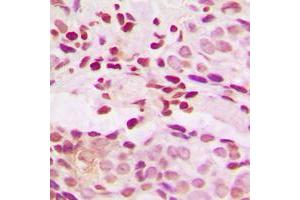 Immunohistochemical analysis of JUNB (pS259) staining in human breast cancer formalin fixed paraffin embedded tissue section. (JunB antibody  (C-Term, pSer259))