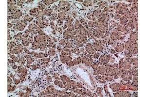 Immunohistochemistry (IHC) analysis of paraffin-embedded Human Pancreas Cancer, antibody was diluted at 1:100.