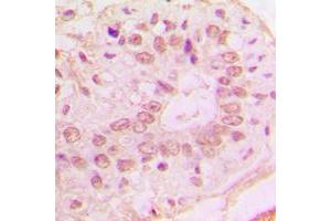 Immunohistochemical analysis of p15 INK4b staining in human lung cancer formalin fixed paraffin embedded tissue section. (CDKN2B antibody  (C-Term))
