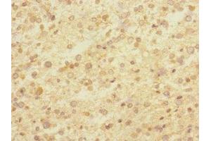 Immunohistochemistry of paraffin-embedded human glioma using ABIN7148481 at dilution of 1:100