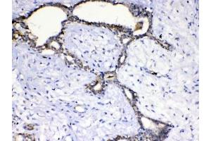 IHC testing of FFPE human breast cancer tissue with SCF antibody at 1ug/ml. (KIT Ligand antibody)