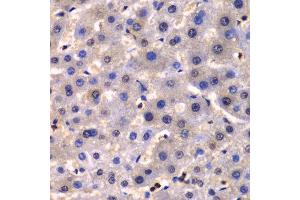 Immunohistochemistry of paraffin-embedded human liver cancer using IKBKG antibody at dilution of 1:100 (400x lens). (IKBKG antibody)