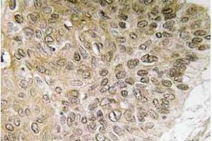 Immunohistochemistry (IHC) analyzes of PI 3-kinase p85alpha antibody in paraffin-embedded human lung carcinoma tissue. (PIK3R1 antibody)