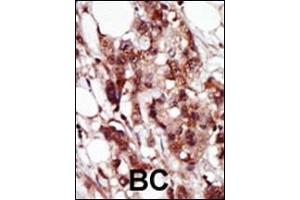 Formalin-fixed and paraffin-embedded human cancer tissue reacted with the primary antibody, which was peroxidase-conjugated to the secondary antibody, followed by AEC staining. (BRD4 antibody  (C-Term))