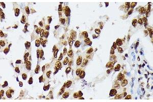Immunohistochemistry of paraffin-embedded Human lung cancer using HNRNPD Polyclonal Antibody at dilution of 1:100 (40x lens).