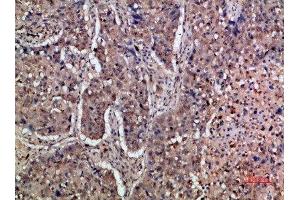Immunohistochemical analysis of paraffin-embedded human-lung-cancer, antibody was diluted at 1:200 (IFNAR1 antibody  (AA 300-350))