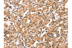 The image on the left is immunohistochemistry of paraffin-embedded Human thyroid cancer tissue using ABIN7190421(CYP46A1 Antibody) at dilution 1/15, on the right is treated with synthetic peptide. (CYP46A1 antibody)