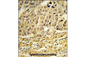 Formalin-fixed and paraffin-embedded human hepatocarcinoma reacted with CCNB1IP1 Antibody , which was peroxidase-conjugated to the secondary antibody, followed by DAB staining. (CCNB1IP1 antibody  (C-Term))