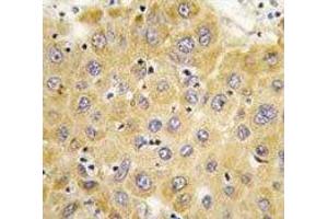 IHC analysis of FFPE human hepatocarcinoma tissue stained with Connective Tissue Growth Factor antibody (CTGF antibody  (AA 315-349))