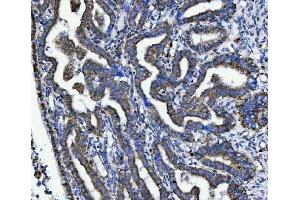 IHC analysis of TRK fused gene/TFG using anti-TRK fused gene/TFG antibody (ABIN7599839). (TFG antibody  (AA 121-400))