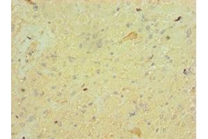 Immunohistochemistry of paraffin-embedded human glioma using ABIN7152828 at dilution of 1:100