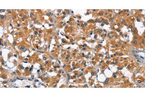 Immunohistochemistry of paraffin-embedded Human thyroid cancer using ARMCX2 Polyclonal Antibody at dilution of 1:40 (ARMCX2 antibody)