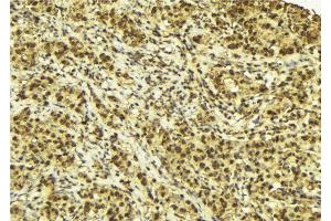 ABIN6272898 at 1/100 staining Human breast cancer tissue by IHC-P. (CRBN antibody)