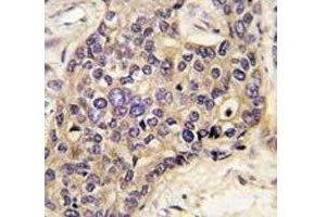 IHC analysis of FFPE human hepatocarcinoma tissue stained with HGF antibody (HGF antibody  (AA 521-554))