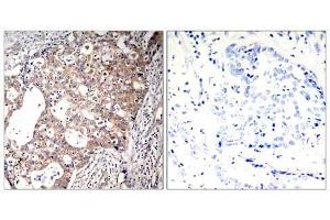 Immunohistochemical analysis of paraffin-embedded human breast carcinoma tissue, using Shc1 (Phospho-Tyr427) antibody (E011317). (SHC1 antibody  (pTyr427))