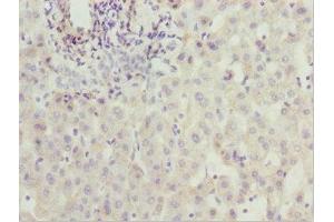 Immunohistochemistry of paraffin-embedded human liver cancer using ABIN7176529 at dilution of 1:100 (ZNF785 antibody  (AA 1-200))