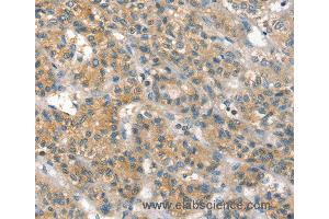 Immunohistochemistry of Human liver cancer using PPP2CA Polyclonal Antibody at dilution of 1:35