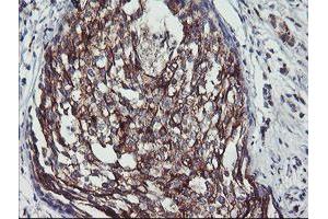 Immunohistochemical staining of paraffin-embedded Adenocarcinoma of Human breast tissue using anti-PPP1R15A mouse monoclonal antibody. (GADD34 antibody)