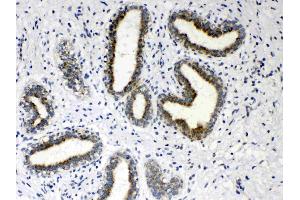 IHC analysis of HSD17B4 using anti- HSD17B4 antibody . (HSD17B4 antibody  (AA 510-736))