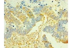 Immunohistochemistry of paraffin-embedded human ovarian cancer using ABIN7158358 at dilution of 1:100 (LIMK2 antibody  (AA 1-240))