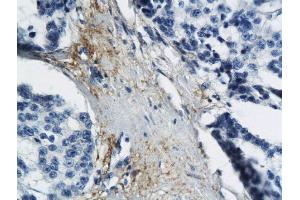 Formalin-fixed and paraffin embedded human breast cancer labeled with Anti MT-ND6 Polyclonal Antibody, Unconjugated  followed by conjugation to the secondary antibody and DAB staining (MT-ND6 antibody  (AA 51-150))
