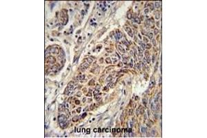 CYC1 Antibody (C-term) (ABIN651531 and ABIN2840281) immunohistochemistry analysis in formalin fixed and paraffin embedded human lung carcinoma followed by peroxidase conjugation of the secondary antibody and DAB staining.