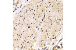 Immunohistochemistry of paraffin-embedded human stomach cancer using TMPRSS2 antibody at dilution of 1:200 (400x lens). (TMPRSS2 antibody)