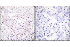 Immunohistochemistry analysis of paraffin-embedded human breast carcinoma tissue, using SENP3 Antibody. (SENP3 antibody  (AA 10-59))