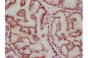 IHC image of ABIN7127346 diluted at 1:115. (Recombinant ATF2 antibody)