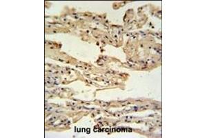 IFM2 Antibody (N-term) (ABIN650963 and ABIN2840011) IHC analysis in formalin fixed and paraffin embedded lung carcinoma followed by peroxidase conjugation of the secondary antibody and DAB staining. (IFITM2 antibody  (N-Term))