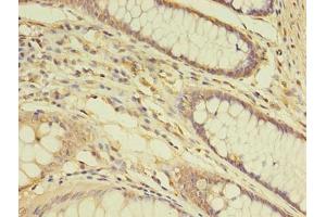 Immunohistochemistry of paraffin-embedded human colon cancer using ABIN7172148 at dilution of 1:100 (THRA antibody  (AA 1-490))