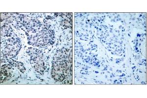 Immunohistochemical analysis of paraffin-embedded human breast carcinoma tissue, using SEK1/MKK4(phospho-Thr261)antibody (E011176). (MAP2K4 antibody  (pThr261))