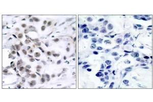 Immunohistochemical analysis of paraffin-embedded human breast carcinoma tissue using Chk1 (Ab-317) antibody (E021114). (CHEK1 antibody)