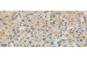 Immunohistochemistry of paraffin-embedded Human liver cancer tissue using ABCC2 Polyclonal Antibody at dilution 1:45 (ABCC2 antibody)